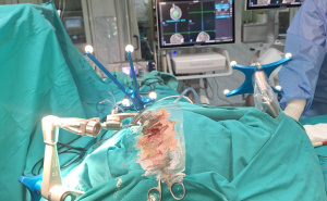 Foto: Kantonalna bolnica Zenica / Prvi put urađena iglena biopsija mozga