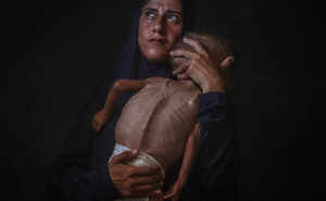Foto: AA / Palestinska beba u Gazi pati od pothranjenosti i prijeti joj smrt