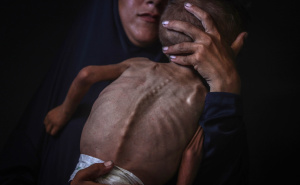 Foto: AA / Palestinska beba u Gazi pati od pothranjenosti i prijeti joj smrt