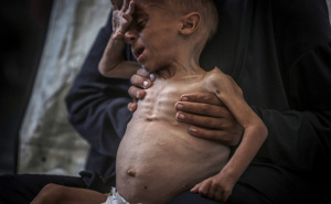 Foto: AA / Palestinska beba u Gazi pati od pothranjenosti i prijeti joj smrt