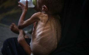 Foto: AA / Palestinska beba u Gazi pati od pothranjenosti i prijeti joj smrt