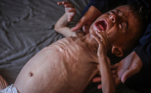 Foto: AA / Palestinska beba u Gazi pati od pothranjenosti i prijeti joj smrt