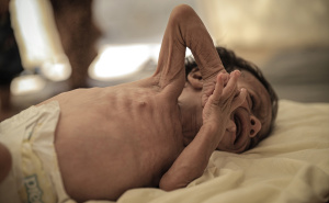 Foto: AA / Pothranjena djeca u Gazi