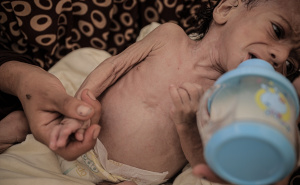 Foto: AA / Pothranjena djeca u Gazi