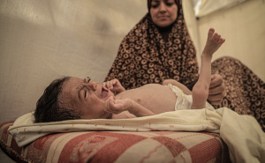 Foto: AA / Pothranjena djeca u Gazi