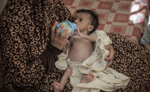 Foto: AA / Pothranjena djeca u Gazi