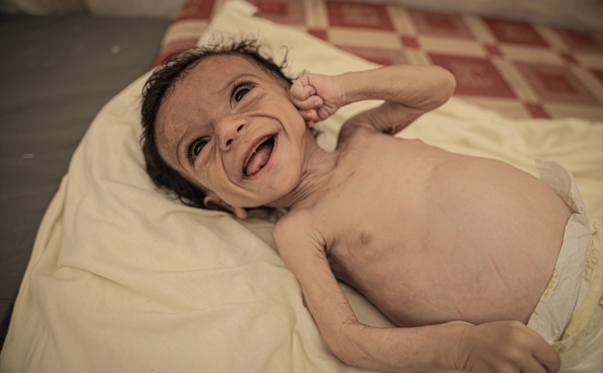 Pothranjena djeca u Gazi