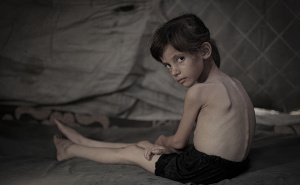 Foto: AA / Lana Salih Juha, pothranjeno dijete