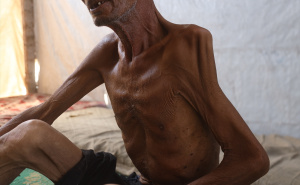 Foto: AA / Palestinac izgubio težinu zbog gladi