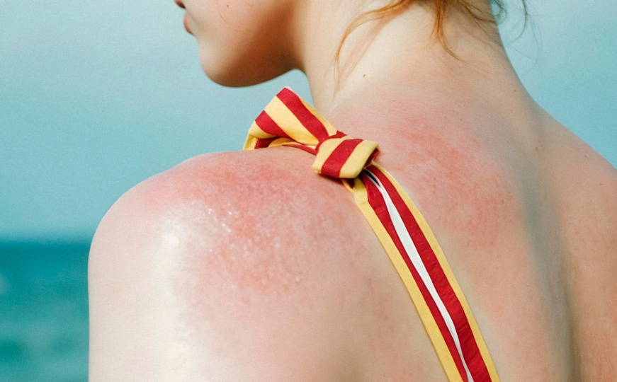 Solarna urtikarija (Ilustracija)