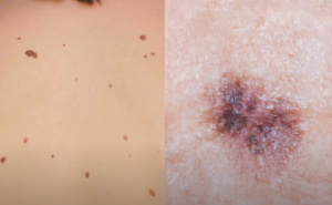 Foto: Collage / Melanom / Ilustracija