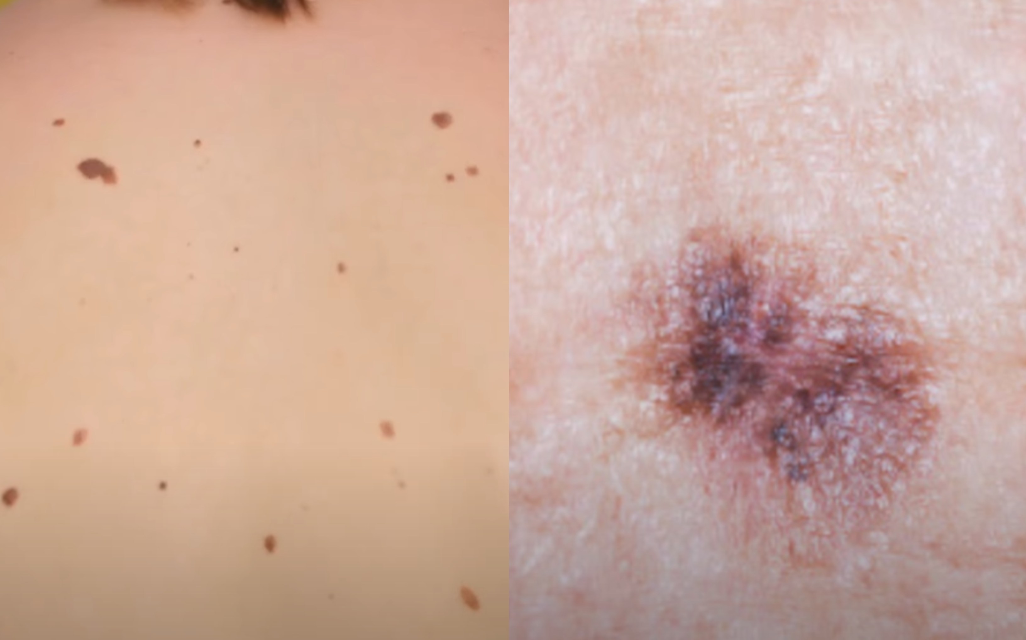 Melanom / Ilustracija