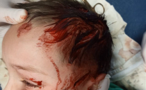 Foto: Ustupljena fotografija / Povrede koje je pas lutalica nanio maloljetniku