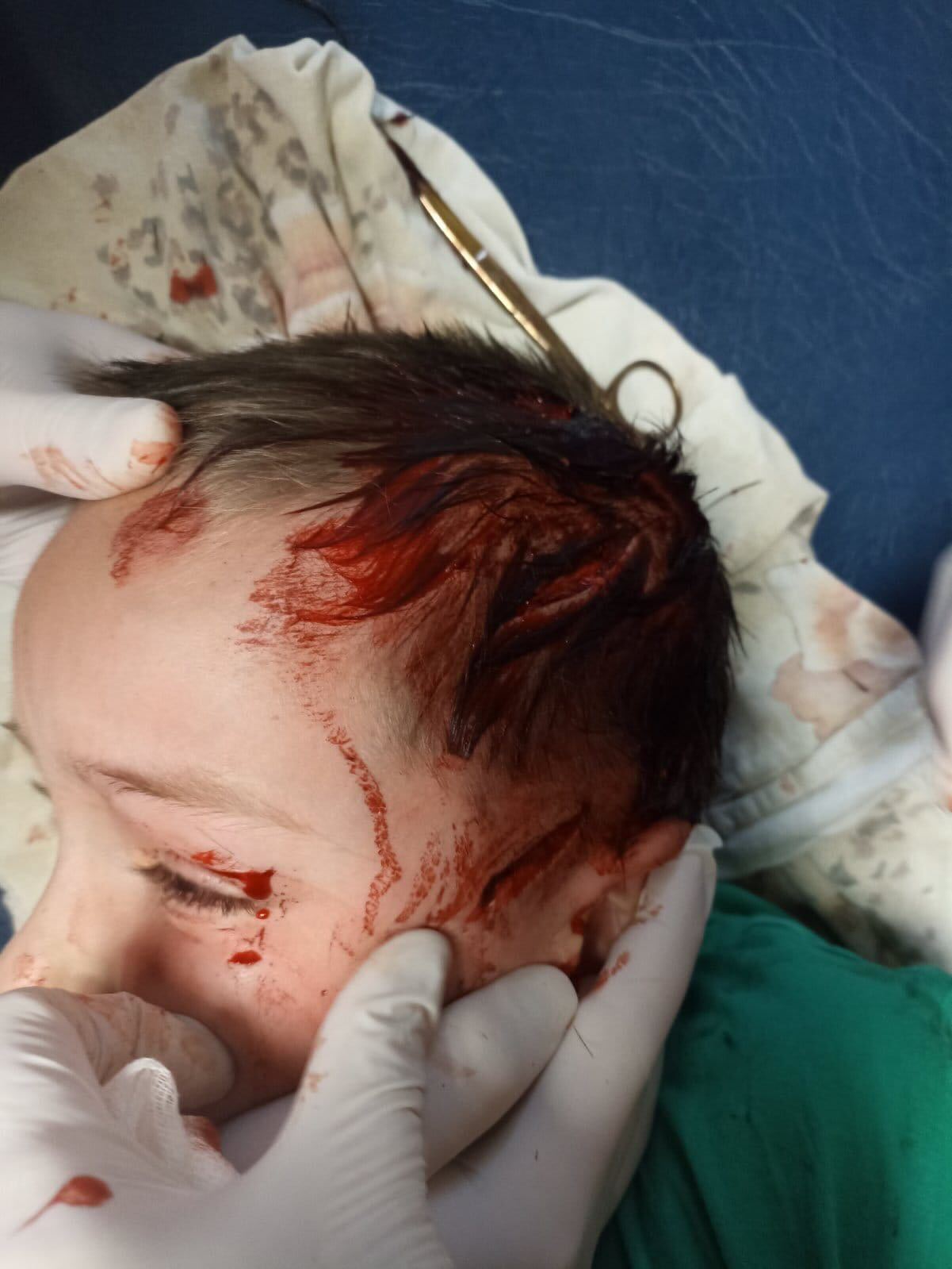 Povrede koje je pas lutalica nanio maloljetniku