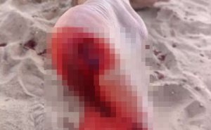 Foto: The Sun / Uznemirujući napadi pirana