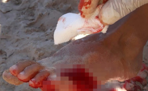 Foto: The Sun / Uznemirujući napadi pirana