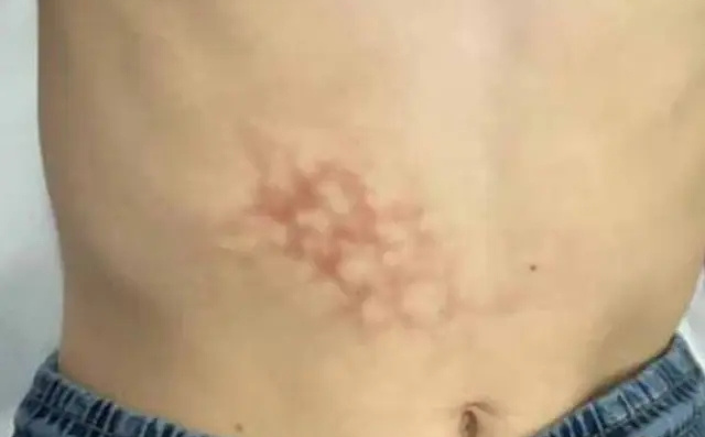 Sindrom prepečene kože kod ovog dječaka